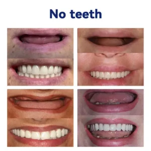 Official Store | Vaxflite™Advanced Full Denture Set 🦷obtained American Dental Association (ADA) certification✅