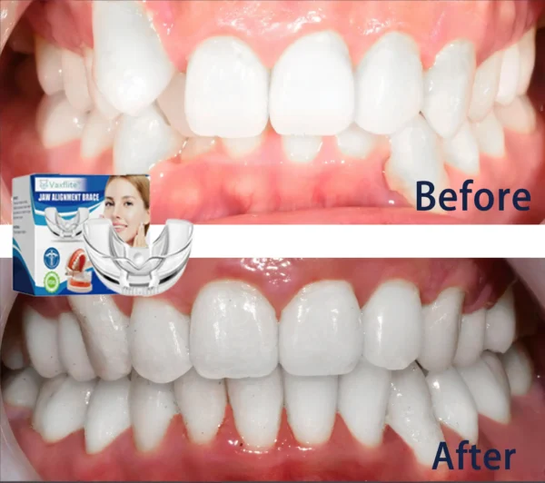 🔥Vaxflite™Mandibular Corrector-For a Healthier, More Aligned Smile🦷🔥
