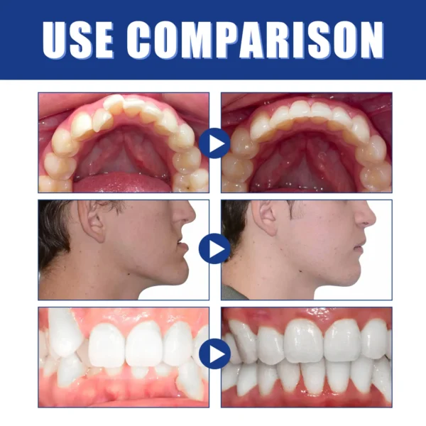 🔥Vaxflite™Mandibular Corrector-For a Healthier, More Aligned Smile🦷🔥