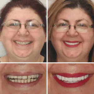 🌟 Vaxflite™ – Custom-Crafted Dentures That Feel as Natural as They Look👩‍🔬
