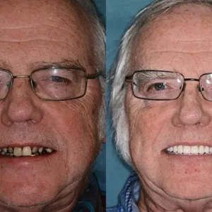 🌟 Vaxflite™ – Custom-Crafted Dentures That Feel as Natural as They Look👩‍🔬