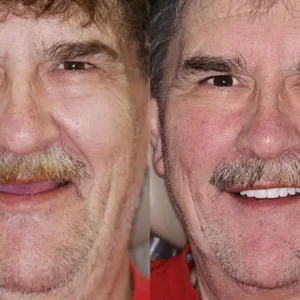 🌟 Vaxflite™ – Custom-Crafted Dentures That Feel as Natural as They Look👩‍🔬