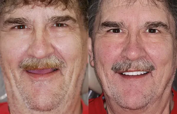 🌟 Vaxflite™ – Custom-Crafted Dentures That Feel as Natural as They Look👩‍🔬