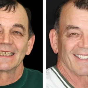 🌟 Vaxflite™ – Custom-Crafted Dentures That Feel as Natural as They Look👩‍🔬