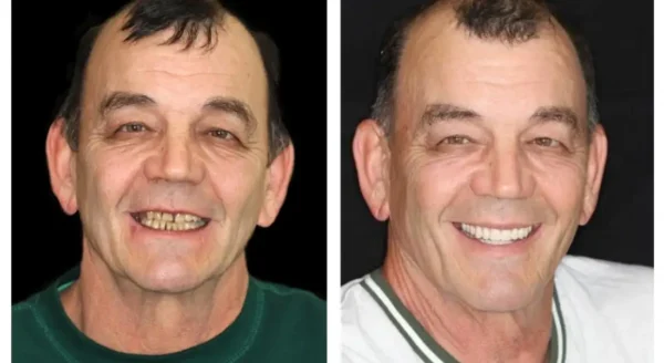 🌟 Vaxflite™ – Custom-Crafted Dentures That Feel as Natural as They Look👩‍🔬