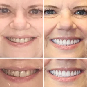 🌟 Vaxflite™ – Custom-Crafted Dentures That Feel as Natural as They Look👩‍🔬