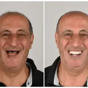 🦷 Denturelix™ Custom-Fit Functional Dentures 😁 Smile with Confidence