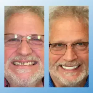 😁 “Snap In. Stay Put. Smile All Day — Or Your Money Back!” 𝗠𝗲𝗱𝗶𝗰𝗮𝗹-𝗚𝗿𝗮𝗱𝗲 𝗙𝘂𝗻𝗰𝘁𝗶𝗼𝗻𝗮𝗹 𝗧𝗵𝗶𝗰𝗸𝗲𝗻𝗲𝗱 𝗗𝗲𝗻𝘁𝘂𝗿𝗲𝘀