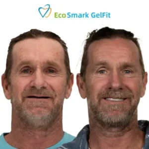 EcoSmark GelFit Dentures