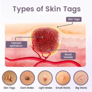 Ceoerty® WartSmooth Renewal Serum