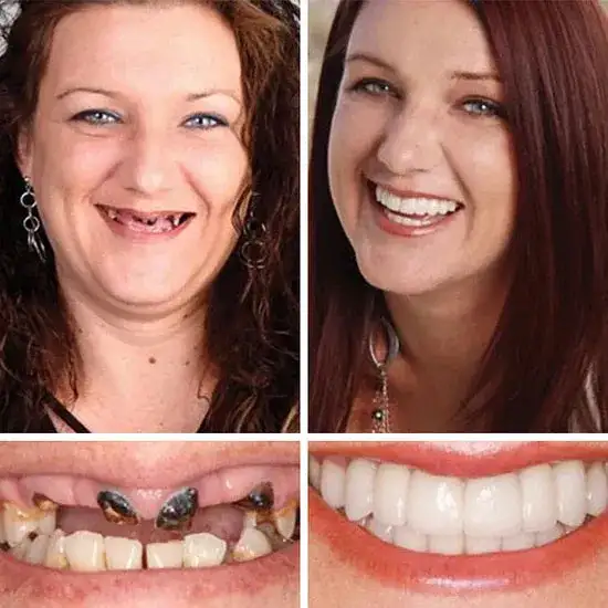 🏆Ends Today: 70% OFF! 🏆2026 Bestselling Product🦷 Fit for a Fresh Smile, Say Goodbye to Wearing Discomfort!🌎
