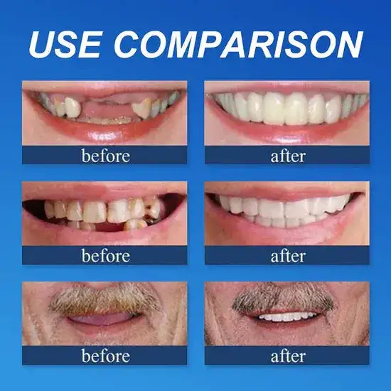 🏆Ends Today: 70% OFF! 🏆2026 Bestselling Product🦷 Fit for a Fresh Smile, Say Goodbye to Wearing Discomfort!🌎