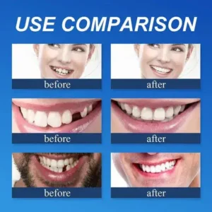 🏆Ends Today: 70% OFF! 🏆2026 Bestselling Product🦷 Fit for a Fresh Smile, Say Goodbye to Wearing Discomfort!🌎