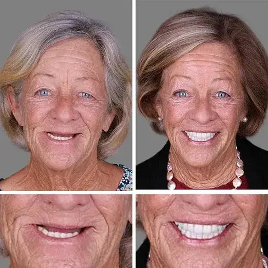 🏆Ends Today: 70% OFF! 🏆2026 Bestselling Product🦷 Fit for a Fresh Smile, Say Goodbye to Wearing Discomfort!🌎