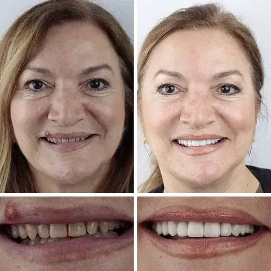⏰Ends Today: 70% OFF! 🌎KLENIMORE™ Custom-Fit Dentures— Designed for Comfort and a Natural-Looking Smile