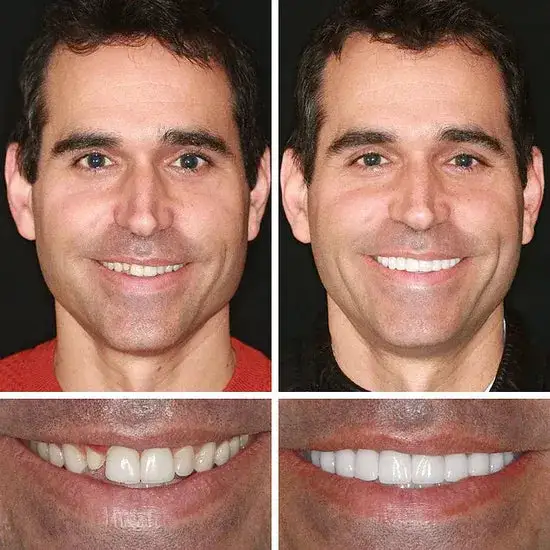 ⏰Ends Today: 70% OFF! 🌎KLENIMORE™ Custom-Fit Dentures— Designed for Comfort and a Natural-Looking Smile