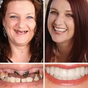 -Ends Today: 70% OFF! ⏰HazyGalaxy™ Medical Full Denture with Strong Suctiond Custom-Fit Full Functional Dentures🦷
