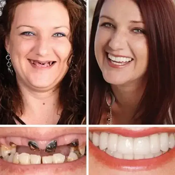 -Ends Today: 70% OFF! ⏰HazyGalaxy™ Medical Full Denture with Strong Suctiond Custom-Fit Full Functional Dentures🦷