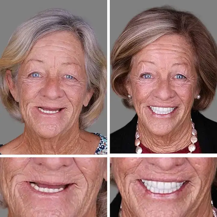 KLENIMORE™ Premium Denture 2026 | Custom-Fit Dentures
