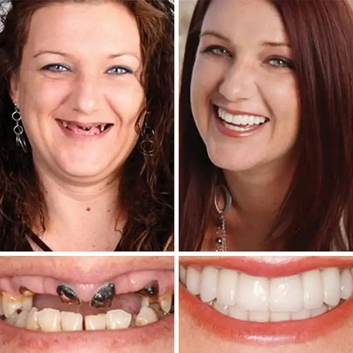 KLENIMORE® Premium Denture 2026 | Secure Custom Fit