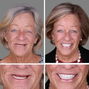KLENIMORE® Premium Denture 2026 | Secure Custom Fit