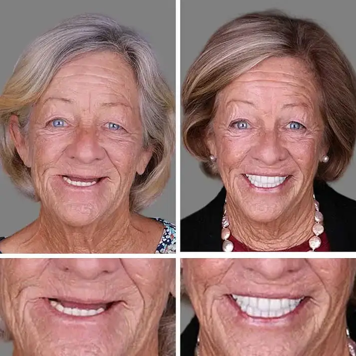 KLENIMORE® Premium Denture 2026 | Secure Custom Fit