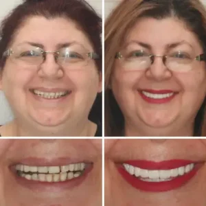 Vaxflite™ PREMIUM DENTURES