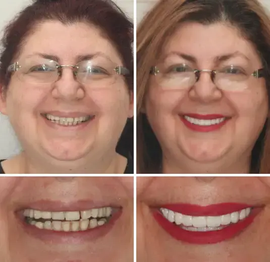 Vaxflite™ PREMIUM DENTURES