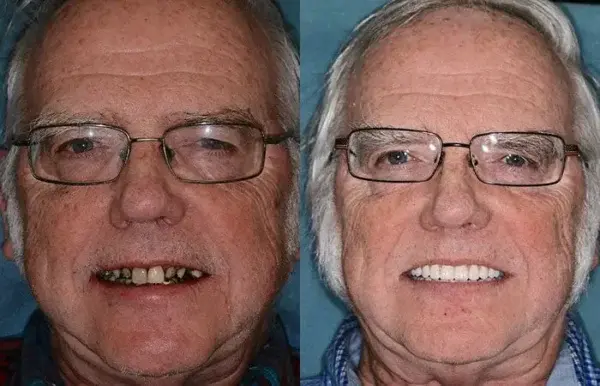Vaxflite™ PREMIUM DENTURES