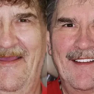 Vaxflite™ PREMIUM DENTURES