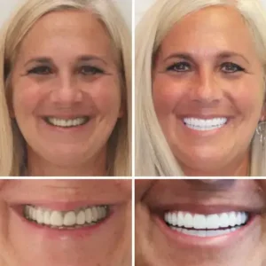 Vaxflite™ PREMIUM DENTURES