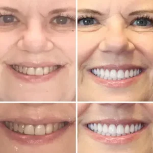 Vaxflite™ PREMIUM DENTURES