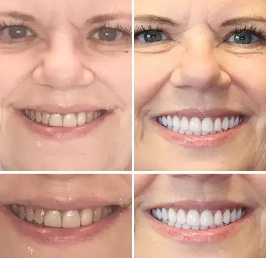 Vaxflite™ PREMIUM DENTURES