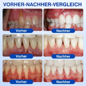 Glimmerly® GumRevive Parodontales Reparaturgel
