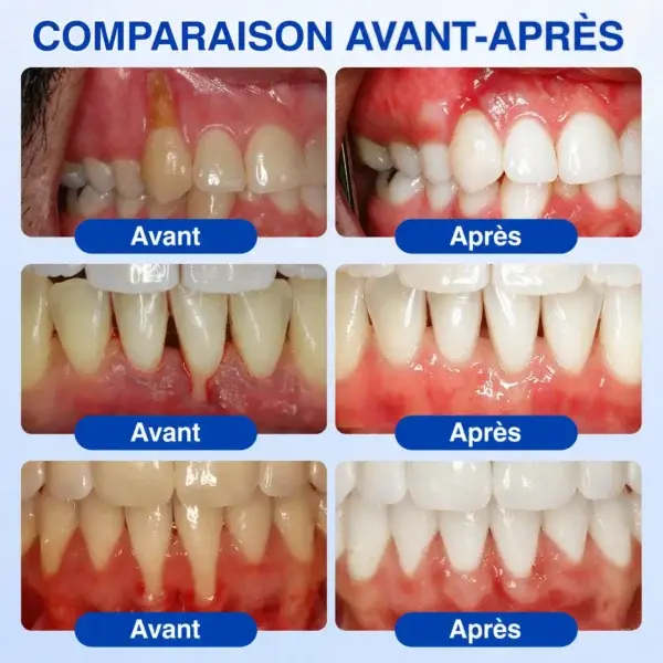 Gel Régénération Parodontale Glimmerly GumRevive